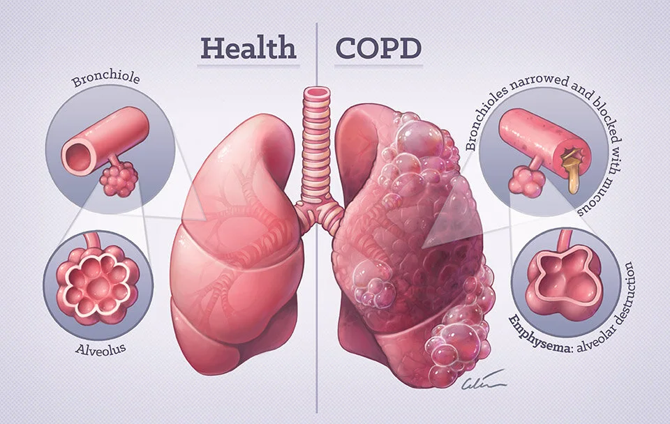 COPD FULL FORM